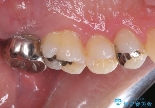 腫れて痛む奥歯 抜歯を覚悟した歯のむし歯治療の治療前