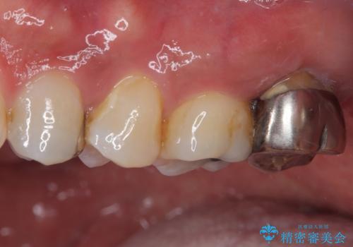 腫れて痛む奥歯 抜歯を覚悟した歯のむし歯治療の治療前