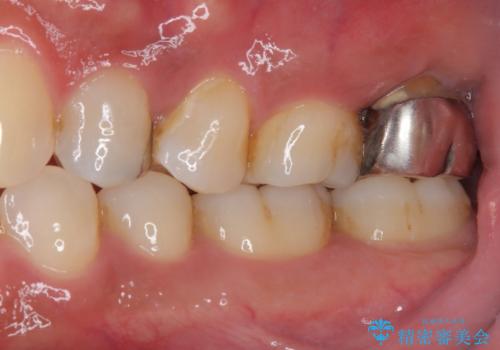 腫れて痛む奥歯　抜歯を覚悟した歯のむし歯治療の治療前