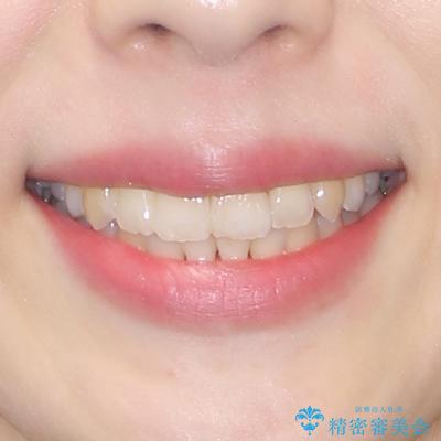 前歯のデコボコをインビザラインで目立たずに改善の治療後(顔貌)