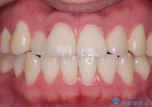 自然な白さへ導いたホワイトニングの症例 治療前