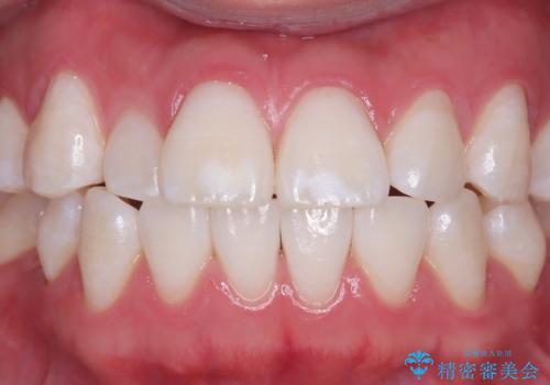 自然な白さへ導いたホワイトニングの症例 治療後
