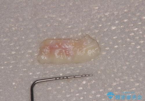 露出した歯根が気になる　歯肉移植による根面被覆術の治療前