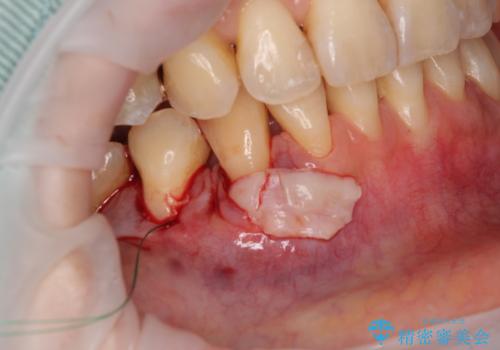 露出した歯根が気になる　歯肉移植による根面被覆術の治療中