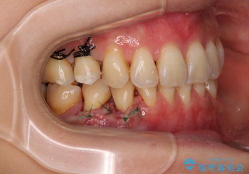 露出した歯根が気になる 歯肉移植による根面被覆術の治療中