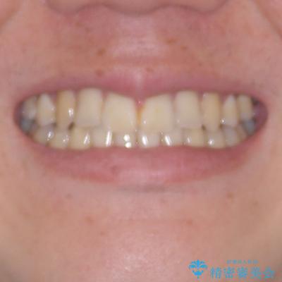 矯正治療の後戻り インビザライン・モデレートパッケージで短期間治療の治療後(顔貌)