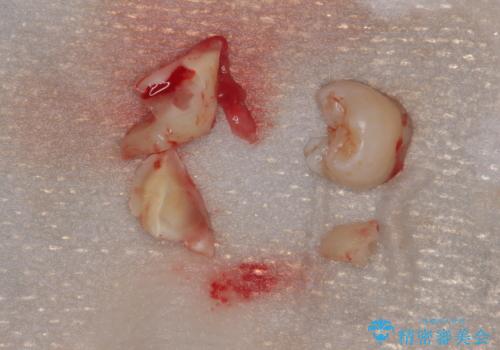 親知らずを抜きたい　親知らず抜歯の治療中