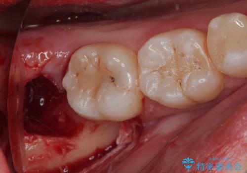 親知らずを抜きたい　親知らず抜歯