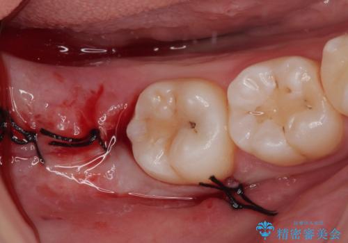 親知らずを抜きたい　親知らず抜歯の症例 治療後