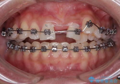 急速拡大装置　狭い上顎歯列を改善して、八重歯を改善した片側抜歯矯正治療の治療中
