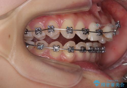 急速拡大装置 狭い上顎歯列を改善して、八重歯を改善した片側抜歯矯正治療の治療中