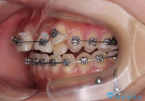急速拡大装置　狭い上顎歯列を改善して、八重歯を改善した片側抜歯矯正治療の治療中