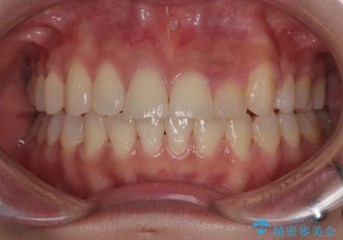 急速拡大装置　狭い上顎歯列を改善して、八重歯を改善した片側抜歯矯正治療