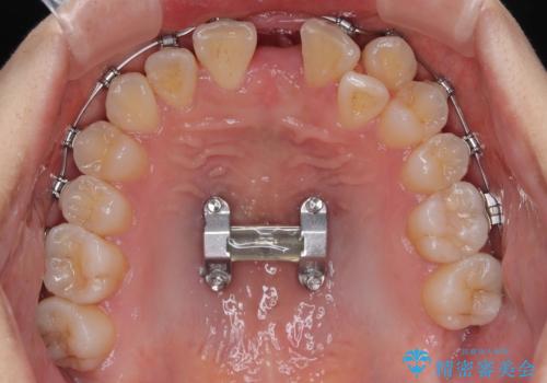 急速拡大装置　狭い上顎歯列を改善して、八重歯を改善した片側抜歯矯正治療の治療中
