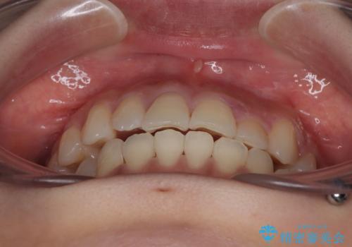 急速拡大装置 狭い上顎歯列を改善して、八重歯を改善した片側抜歯矯正治療の治療後