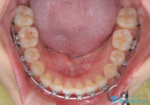 急速拡大装置 狭い上顎歯列を改善して、八重歯を改善した片側抜歯矯正治療の治療中