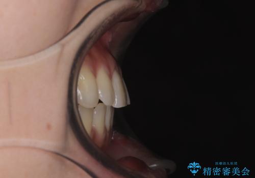 急速拡大装置　狭い上顎歯列を改善して、八重歯を改善した片側抜歯矯正治療の治療後