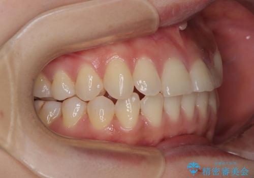 急速拡大装置　狭い上顎歯列を改善して、八重歯を改善した片側抜歯矯正治療の治療後