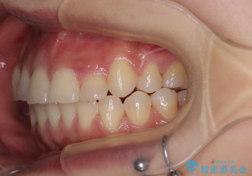 急速拡大装置　狭い上顎歯列を改善して、八重歯を改善した片側抜歯矯正治療の治療後