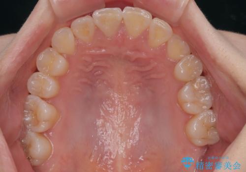 急速拡大装置 狭い上顎歯列を改善して、八重歯を改善した片側抜歯矯正治療の治療後