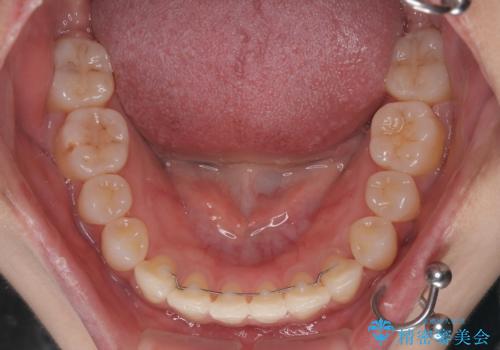 急速拡大装置　狭い上顎歯列を改善して、八重歯を改善した片側抜歯矯正治療の治療後