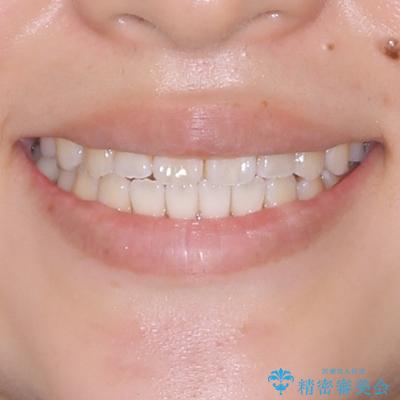 舌の突出癖が原因 インビザライン矯正による開咬改善の治療後(顔貌)