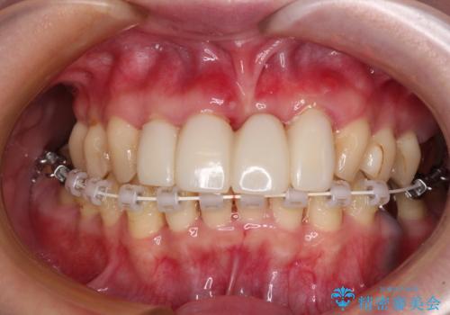 かかりつけ医の治療方針に疑問 歯周病治療と矯正治療を合わせた総合歯科治療の治療中