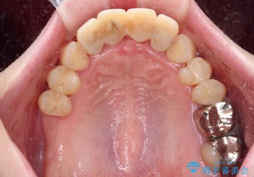 かかりつけ医の治療方針に疑問　歯周病治療と矯正治療を合わせた総合歯科治療の治療中