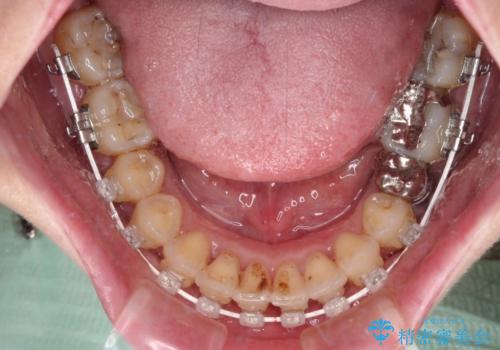 かかりつけ医の治療方針に疑問　歯周病治療と矯正治療を合わせた総合歯科治療の治療中