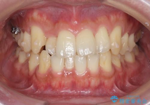 [ インビザライン矯正 ]  マウスピースで治す、すきっ歯　がたつきの治療中