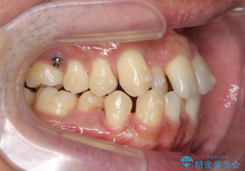 [ インビザライン矯正 ]  マウスピースで治す、すきっ歯　がたつきの治療中