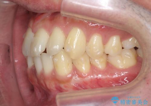 [ インビザライン矯正 ]  マウスピースで治す、すきっ歯　がたつきの治療中