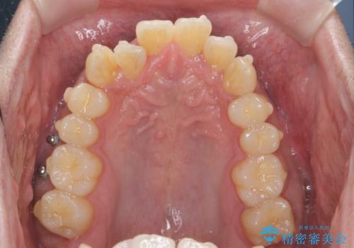 [ インビザライン矯正 ]  マウスピースで治す、すきっ歯　がたつきの治療中