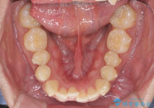 [ インビザライン矯正 ]  マウスピースで治す、すきっ歯　がたつきの治療中