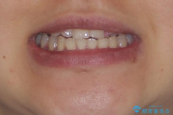 急速拡大装置 狭い上顎歯列を改善して、八重歯を改善した片側抜歯矯正治療の治療前(顔貌)
