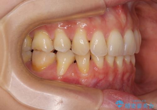 露出した歯根が気になる 歯肉移植による根面被覆術の治療前