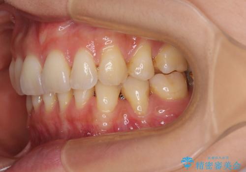 露出した歯根が気になる　歯肉移植による根面被覆術の治療前