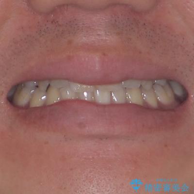矯正治療の後戻り インビザライン・モデレートパッケージで短期間治療の治療前(顔貌)