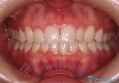 【インビザライン】がたつきを綺麗にしたいの治療後