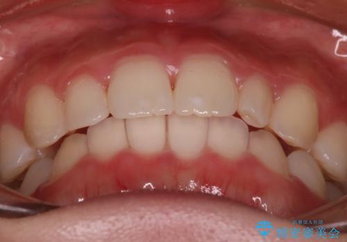 【インビザライン】がたつきを綺麗にしたいの治療後