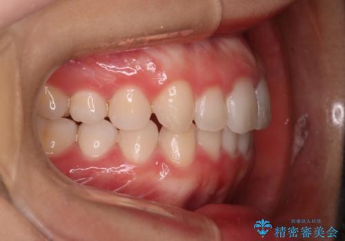 【インビザライン】がたつきを綺麗にしたいの治療後