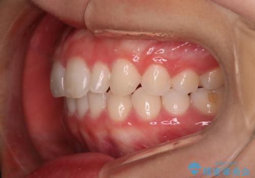 【インビザライン】がたつきを綺麗にしたいの治療後