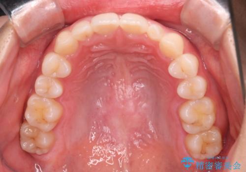 【インビザライン】がたつきを綺麗にしたいの治療後