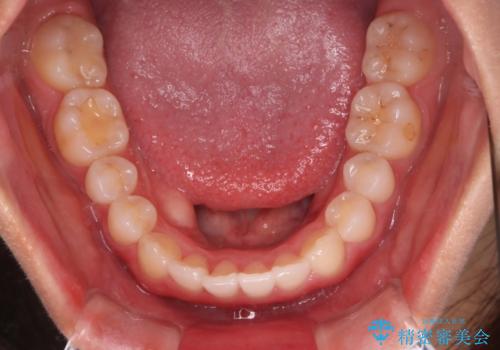 【インビザライン】がたつきを綺麗にしたいの治療後