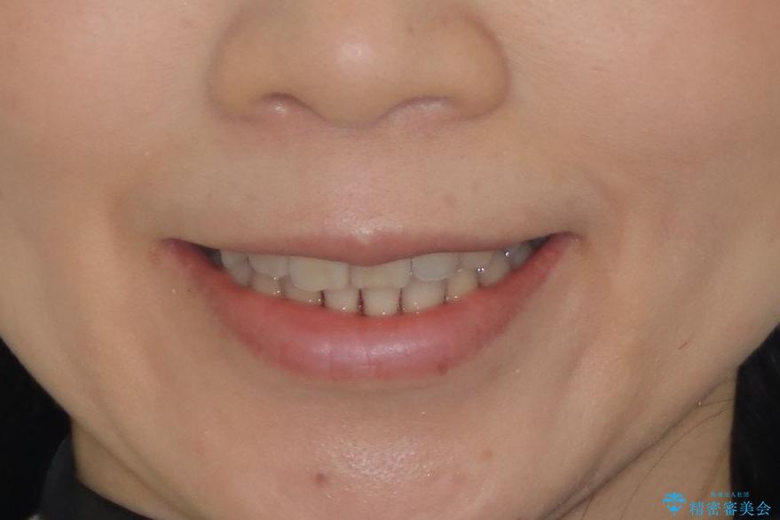 目立たないマウスピースで八重歯を解消。右上5番の抜歯スペースを活用したインビザライン矯正の治療後(顔貌)