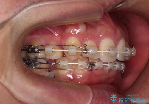 狭くて前方に飛び出した歯列　拡大装置を併用したワイヤー抜歯矯正治療の治療中