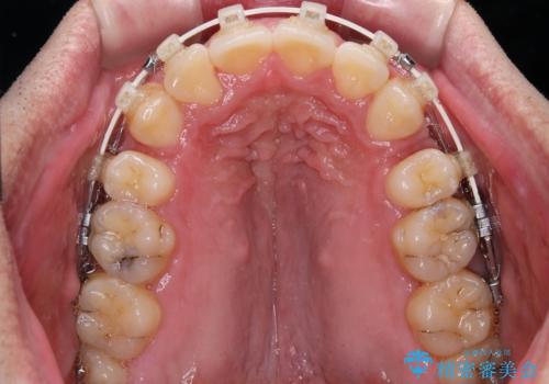 狭くて前方に飛び出した歯列　拡大装置を併用したワイヤー抜歯矯正治療の治療中