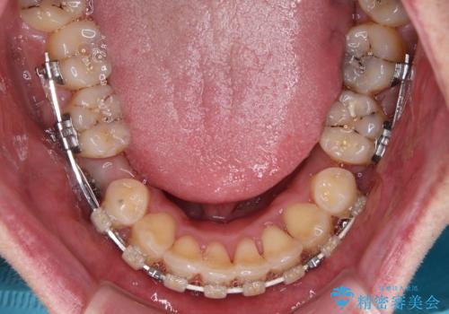 狭くて前方に飛び出した歯列　拡大装置を併用したワイヤー抜歯矯正治療の治療中