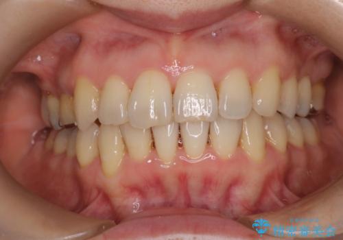 目立たないマウスピースで八重歯を解消。右上5番の抜歯スペースを活用したインビザライン矯正の症例 治療後