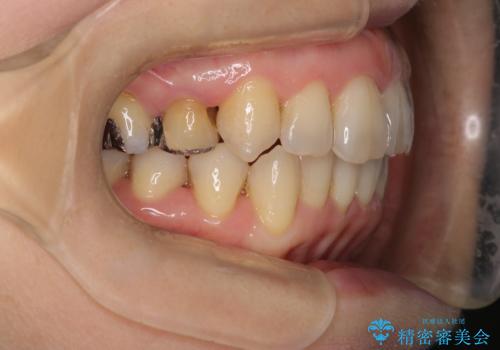 目立たないマウスピースで八重歯を解消。右上5番の抜歯スペースを活用したインビザライン矯正の治療後